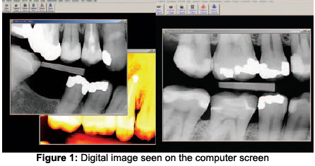 a tooth x-ray